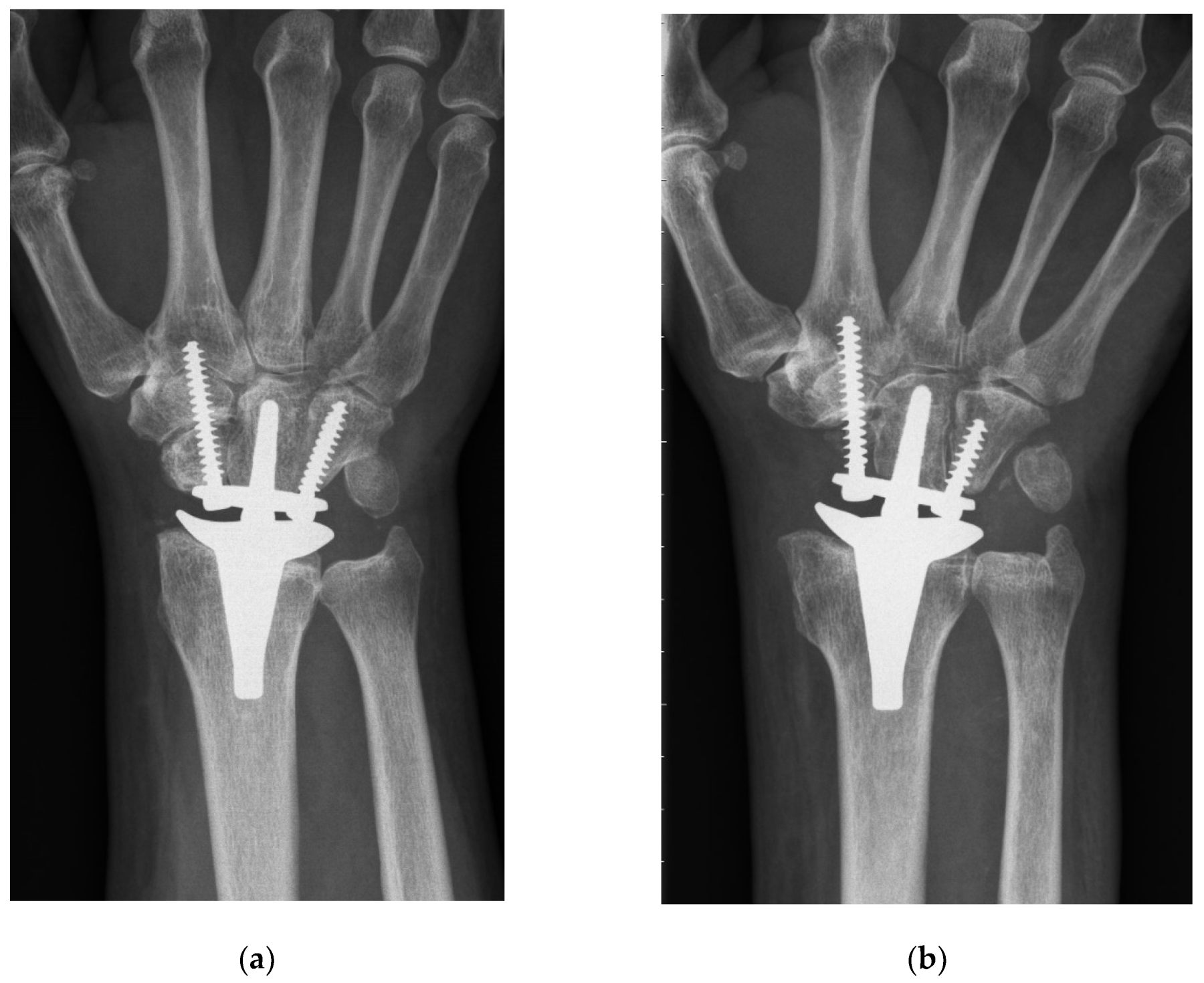 Wrist Joint Replacement xray